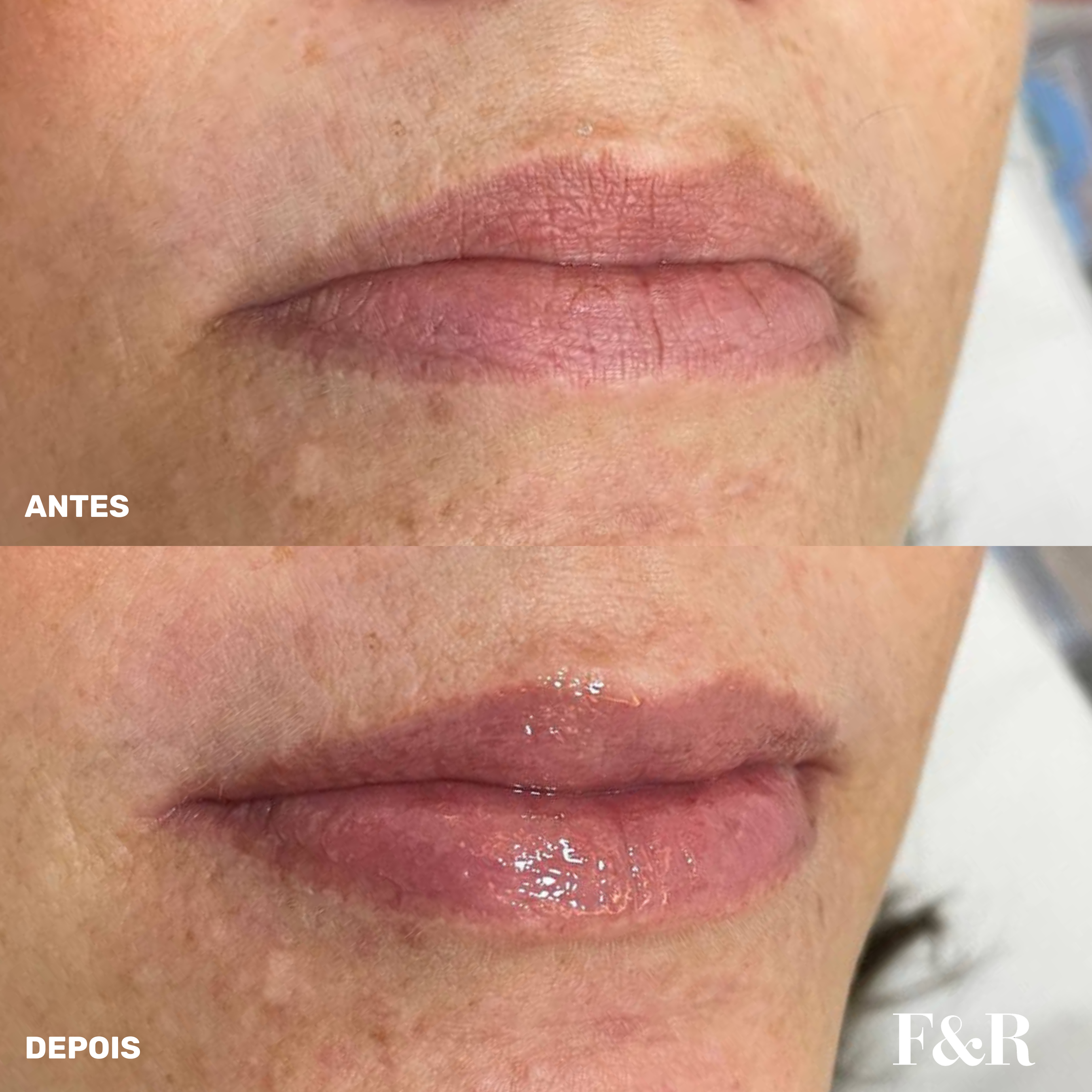 Hydra Lips — resultado